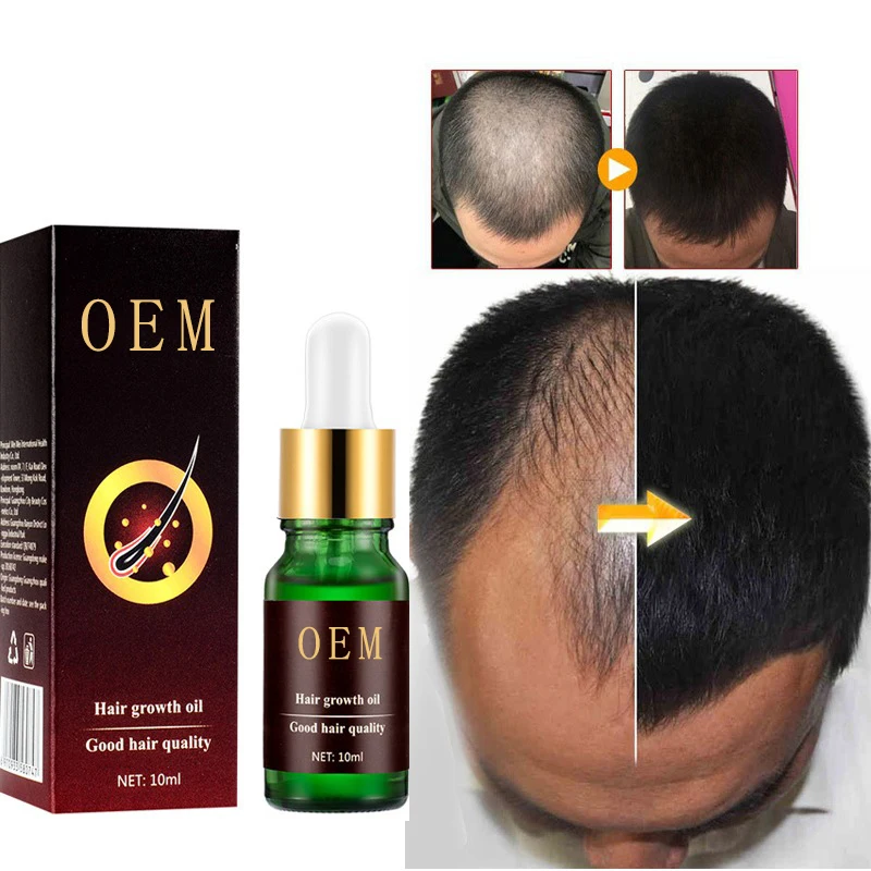 Anti Loss Treatment Hair Care Ginger Treatment Serum Dry Frizzy Damaged Thinning Scalp Growth Essential Oils