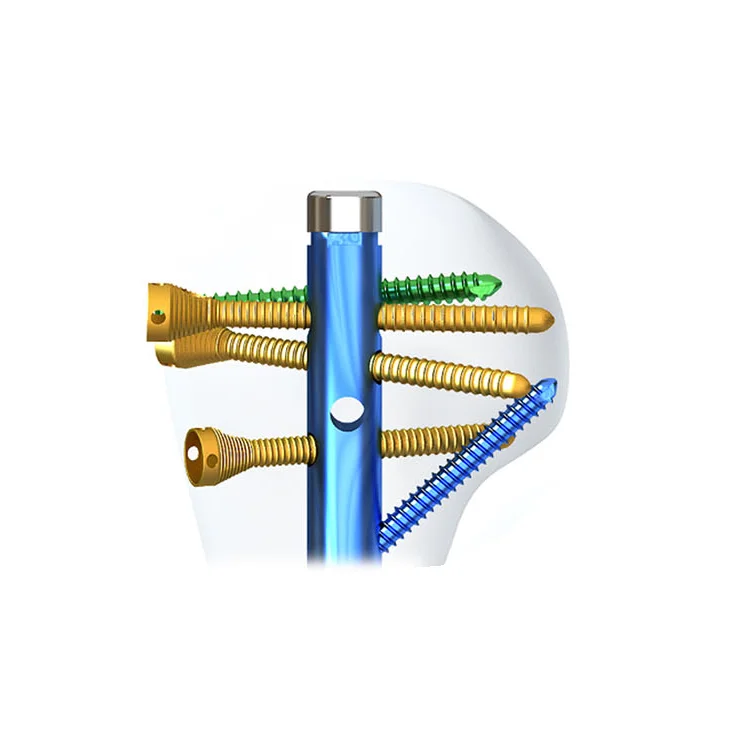 Trauma Orthopedic Implants Interlocking Titanium Nail Multi-Lock Humeral Intramedullary Nail