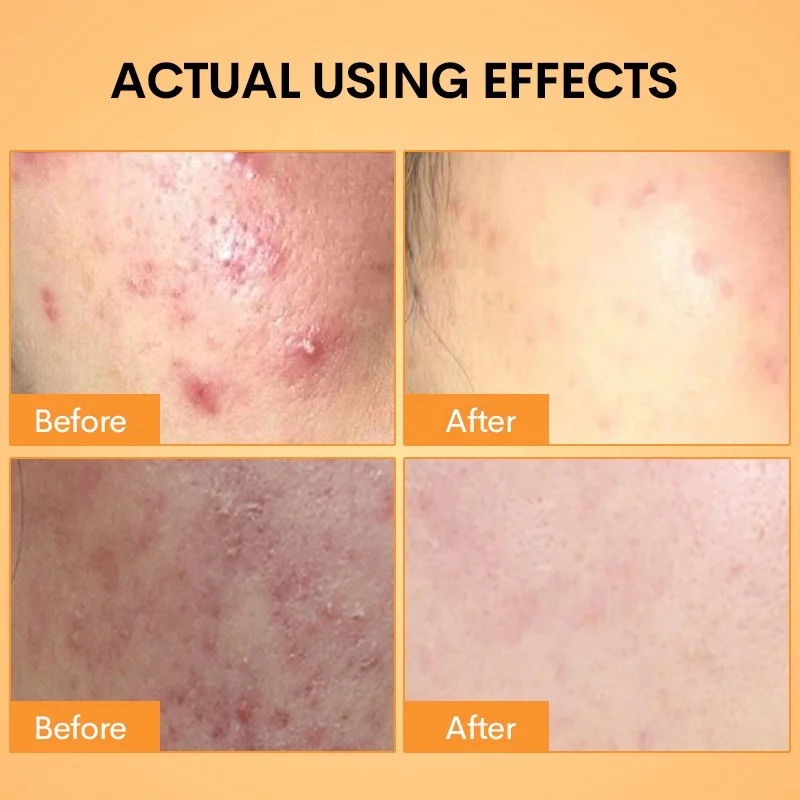 Tumeric skin care set Private label 7n1 Turmeric WITH Vitamin C Whitening Dark Spot Acne Treatment Skin Care Turmeric Set