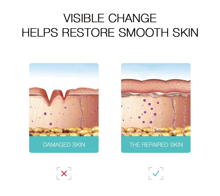 Essing Newest Innovation No-surgical For Beauty Center Stretch Mark Removal Machine