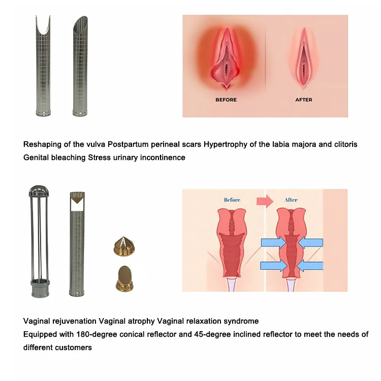 Fractional Co2 Laser Vaginal Tightening Medical Scar Acne Removal