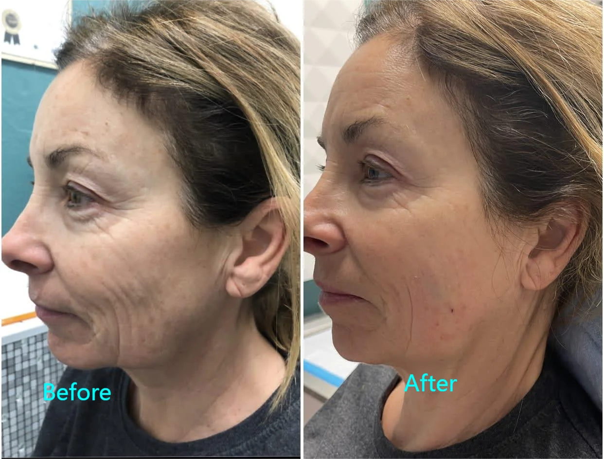 Endo laser lfting.png