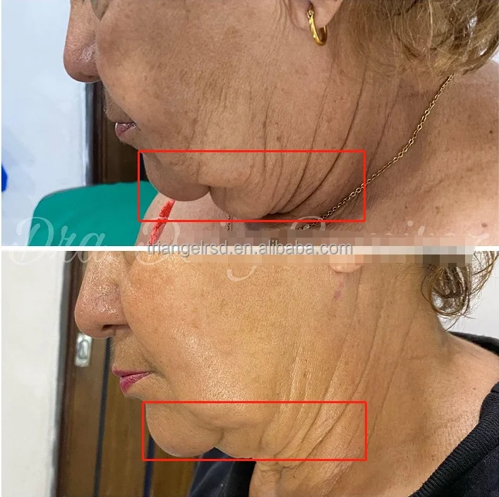 Newest 980nm Diode Laser Liposuction 1470nm Laser Lipolysis Anti Cellulite Weight Laser