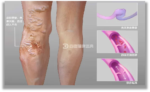 Advanced medical home use Portable Interference electrotherapy physiotherapy machine for promote tissue healing