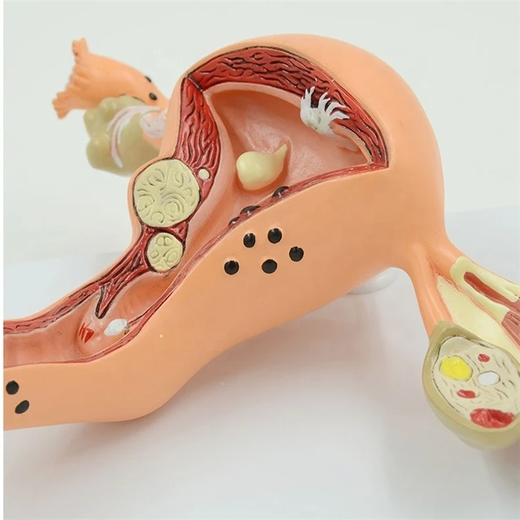 Factory Educational equipment female human anatomy uterine lesion model PVC anatomical model