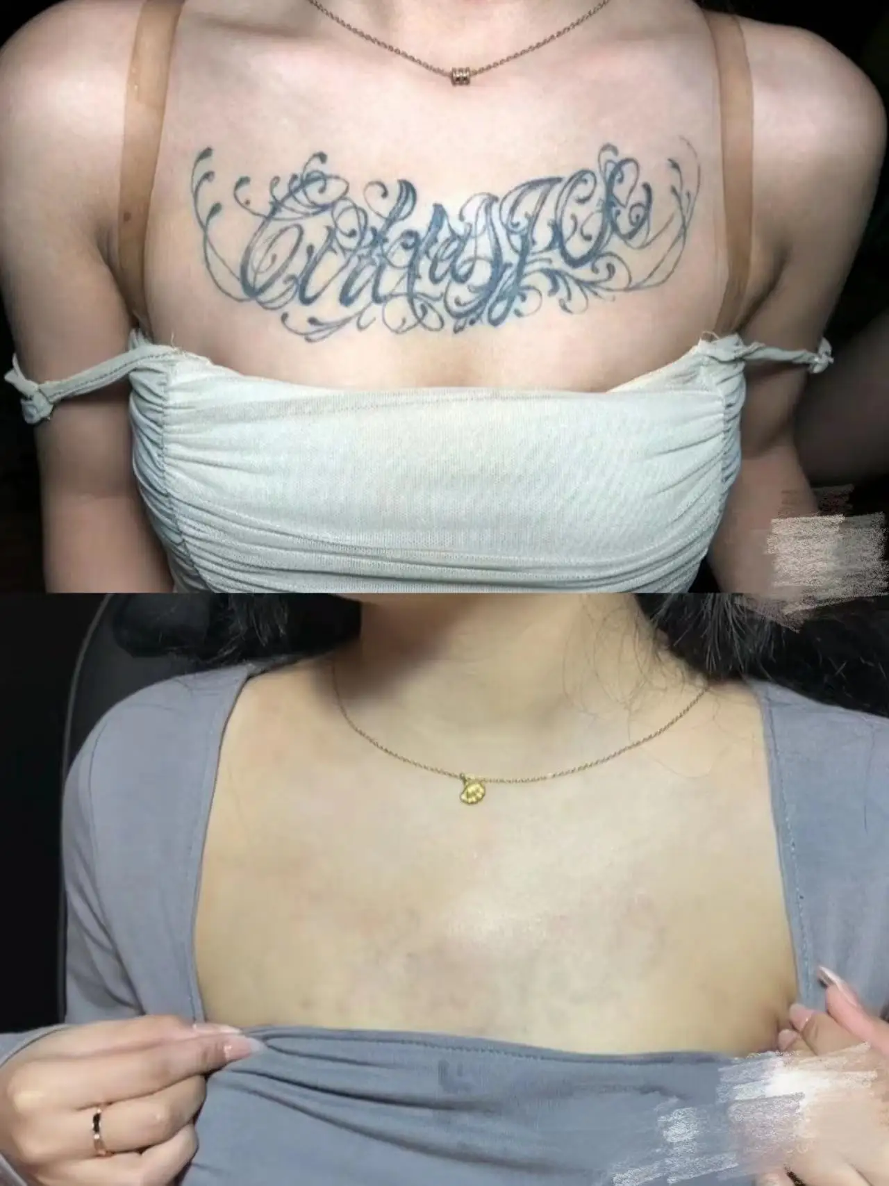 Pico laser machine 532nm 1064nm 1320nm tattoo removal acne treatment medical equipment