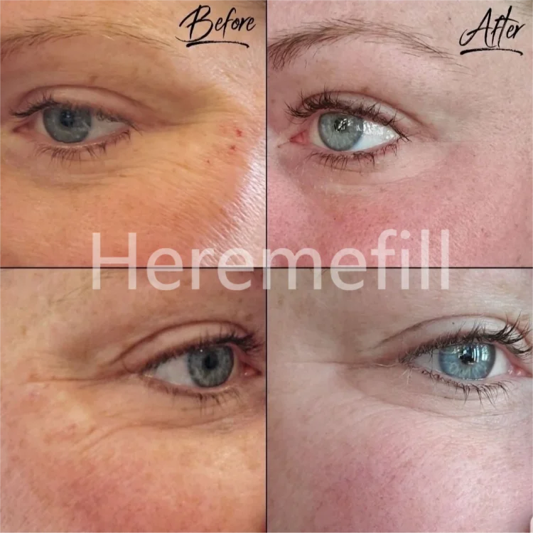 Heremefill  Injecting cross-linked gel hyaluronic acid skin filling facial filler facial wrinkles