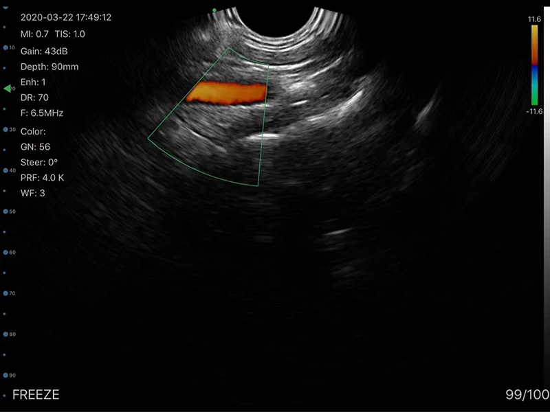 Transvaginal Single Wireless Ultrasound Probe for GY OB