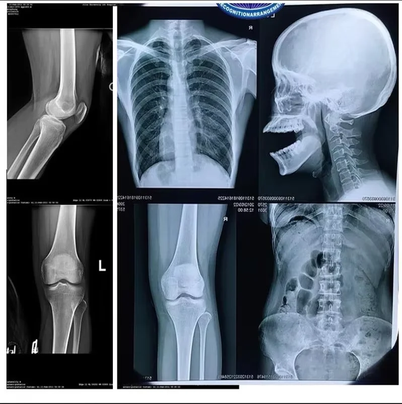 100 Pieces Per Pack A4 14'x17' Medical Inkjet X-ray Imaging Blue Film for medical devices