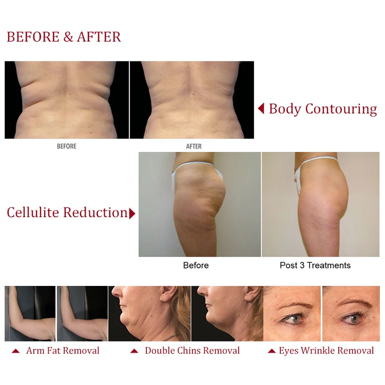 
Vacuum Liposuction+Infrared + RF Roller Massage Slimming Machine CE. 