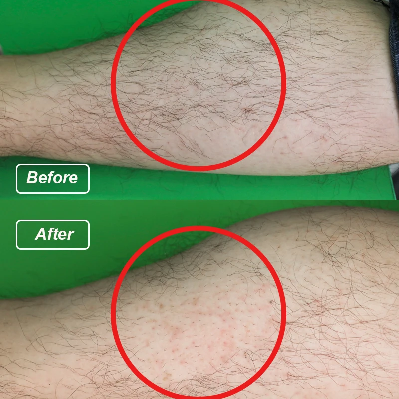 Cosmedplus high-end alexandrite laser harre entfernung Long pulse ND yag laser 1064nm 755nm Alexandrite laser hair removal