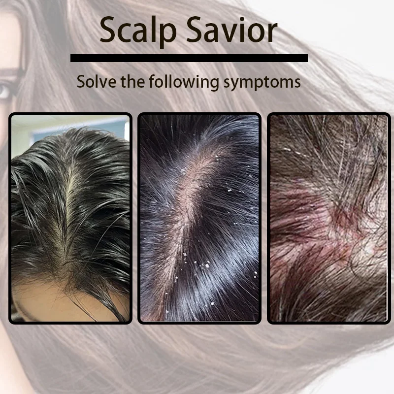 ZS Wholesale Scalp Relief Anti-Dandruff Lyophilized Powder Follicle Repair Deep Cleaning Anti-Hair Loss Hair Growth Serum