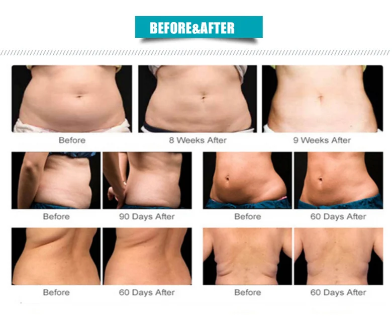 RF Calvitation En Lipo Laser Ultracavitador Ultracavitacion Cativation Slimming Fat Reduction Cavation 6 In 1 Cavitation Machine