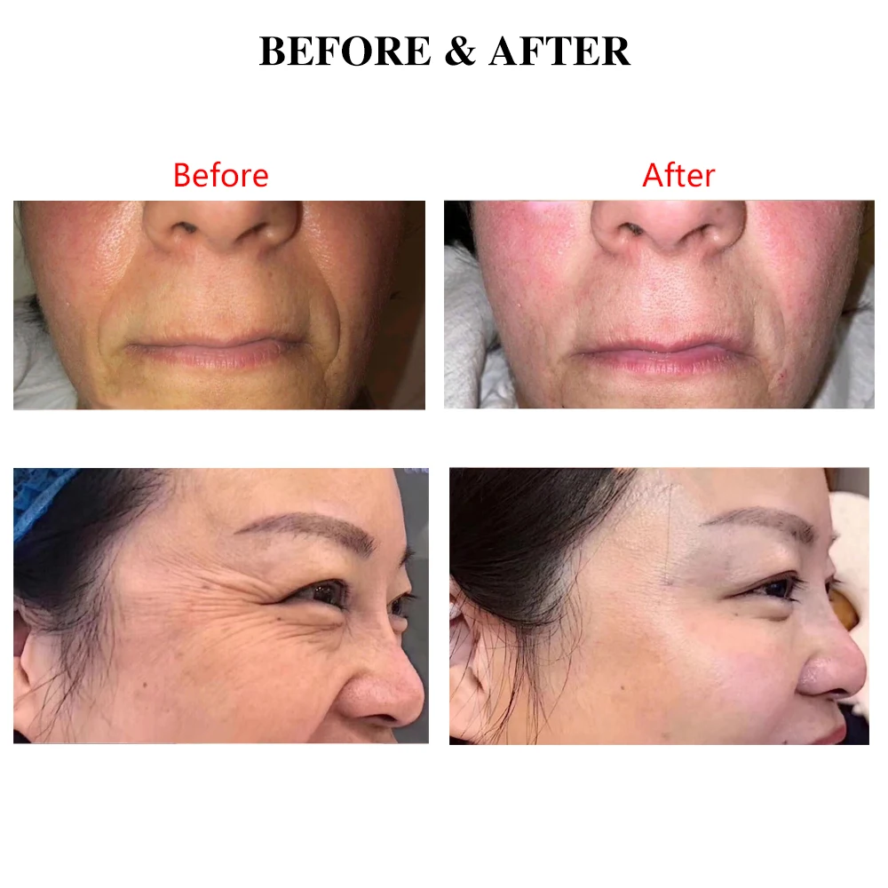 
Best Seller Korea Hilos Mono 29g 50mm Pcl Polycaprolactone Thread For Low Price 