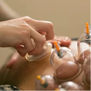 hijama cups steried ventosa chinas terapias multiple wet cupping body massage chines cupping