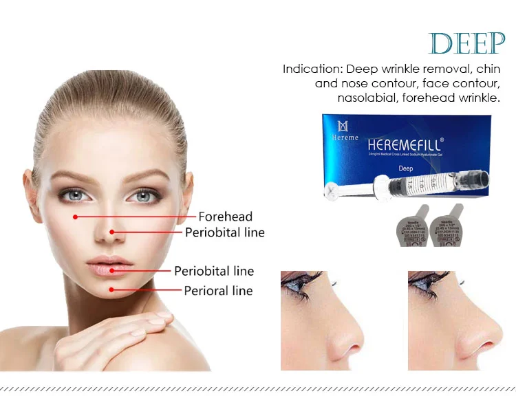 Wholesales Price 24mg/ML Ha Dermal Filler Injection Cross Linked Hyaluronic Acid Korea Dermal Filler