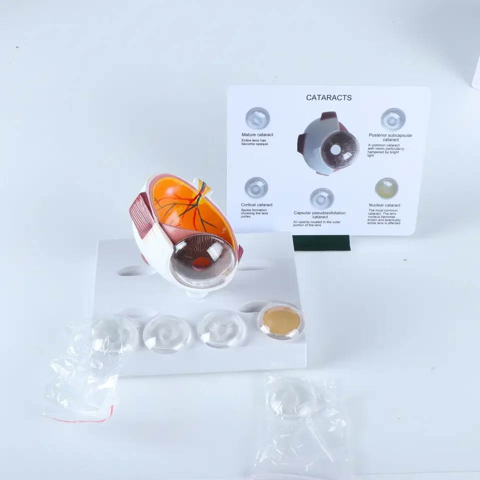Eye Pathological Anatomical Model For Medical Education Eye Disease Model Of Cataract