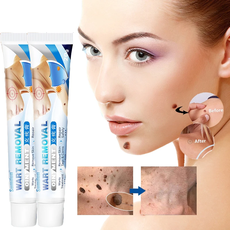20g Warts Remover Ointment Wart Treatment Cream Skin Tag Remover Herbal Extract Corn Plaster Warts Ointment