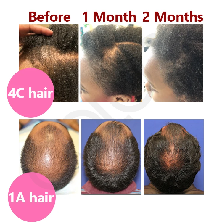 Oalen Hair Care Promote Hair Growth Massage Nourishing Saver Relieve Scalp Tension Refreshing Mint Scalp Oil