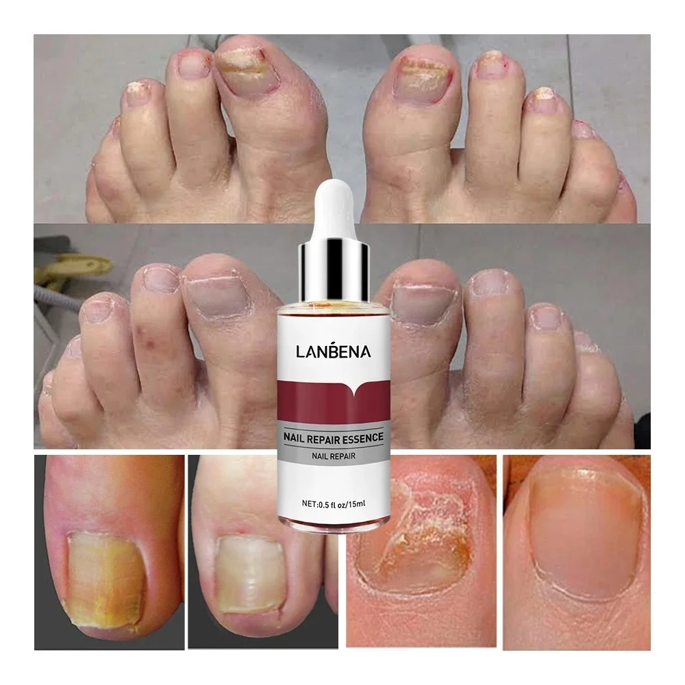 Lanbena nail treatment anti fungal nail solution nail repair essence