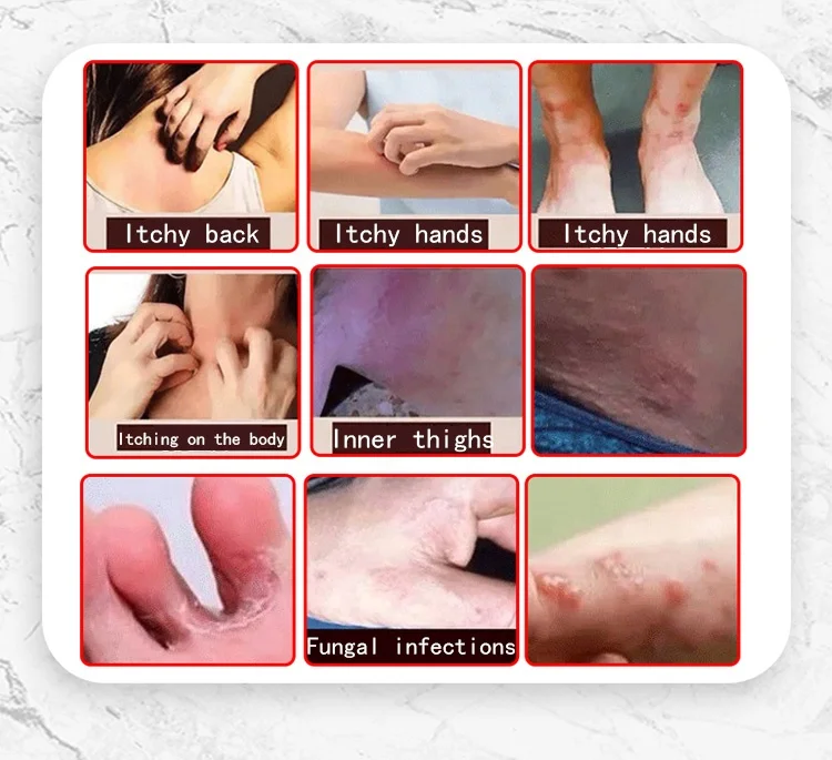 Anti-inflammatory Itching Relieve Skin Herbal  Disease Relieve Itching Pruritus Psoriasis Cream Ointment