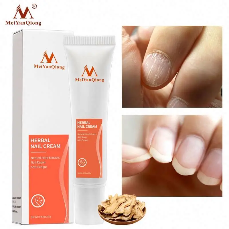 Discount OEM Meiyanqiong Chinese Herbal Treatment Onychomycosis Anti-fungal Nail Cream Discount OEM Meiyanqiong Chinese Herbal