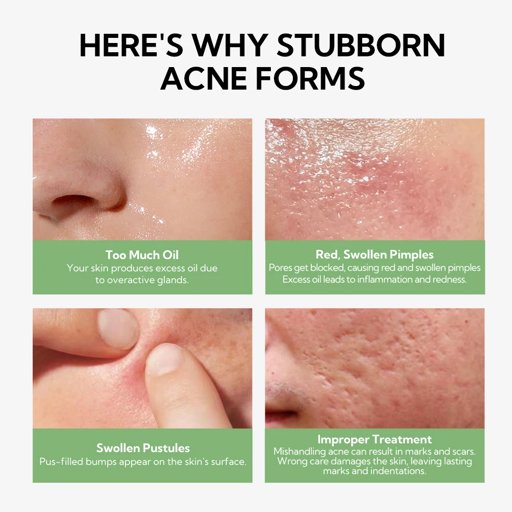 LANBENA Skin anti acne serum with 5% Niacinamide + 2% Salicylic Acid for Skin Repairing clears with 20pcs Cotton swab