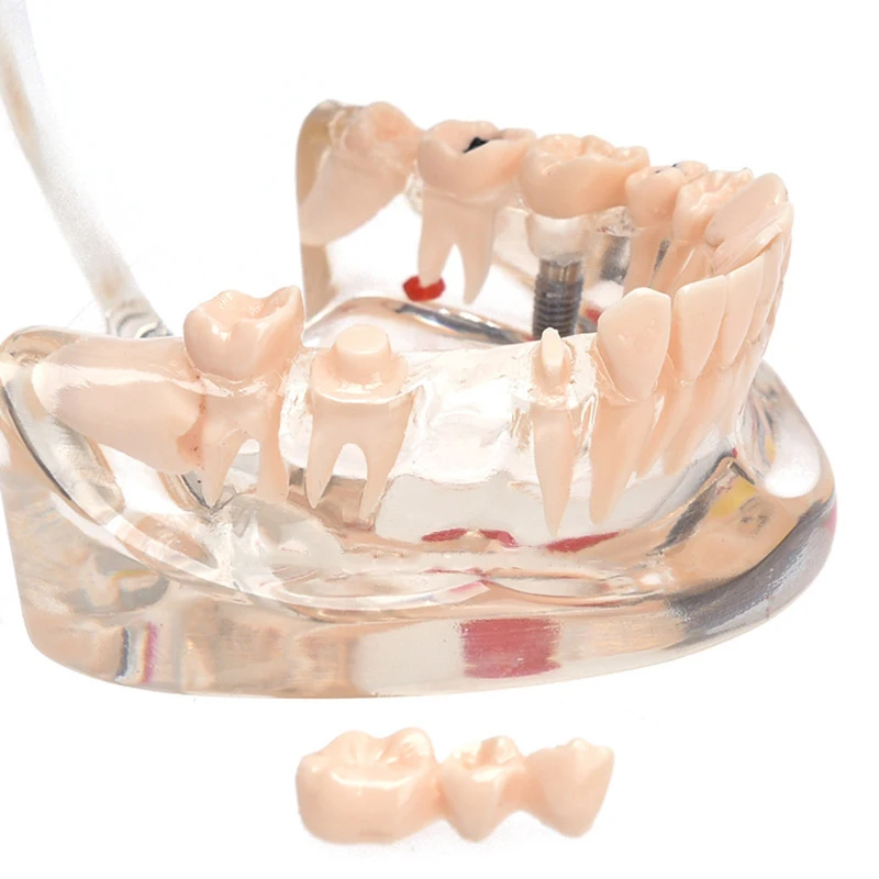 High quality lab typodont dental model practice dental implant model