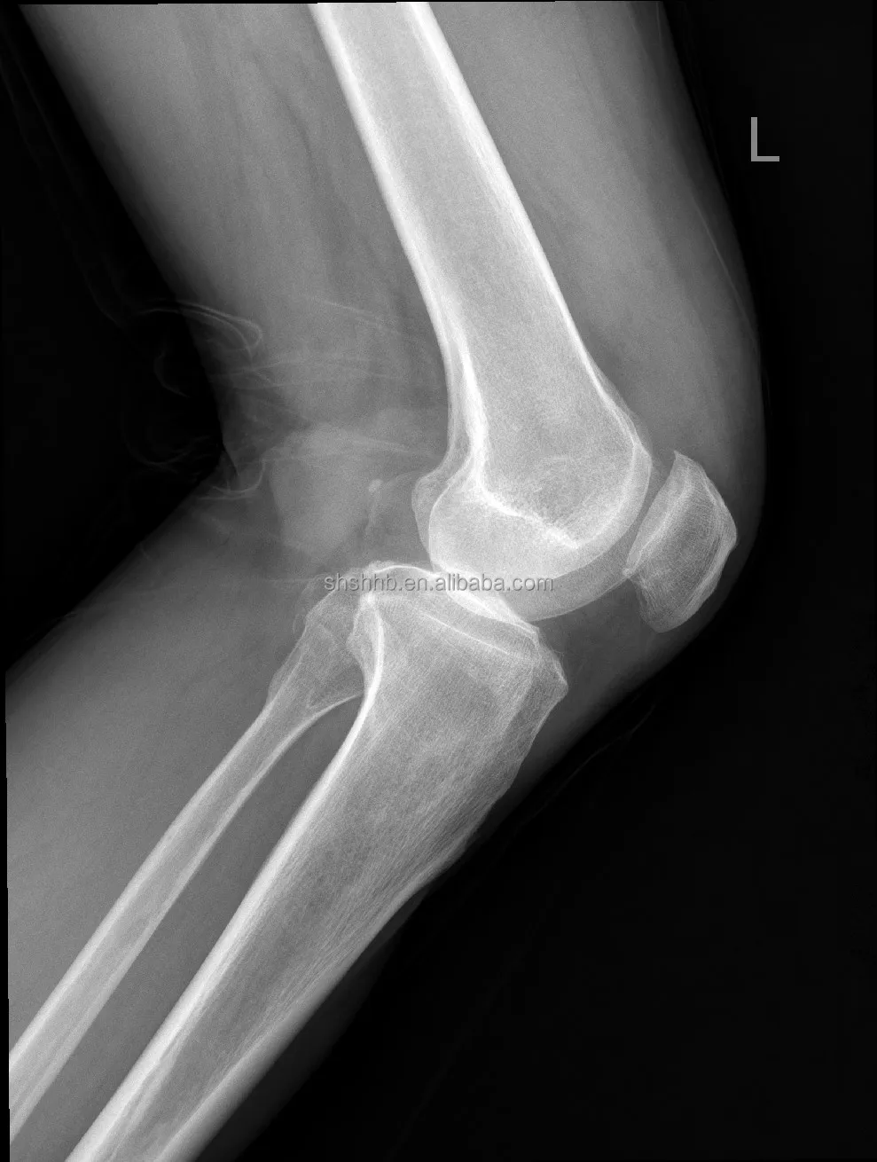 17*17 DR Multipurpose digital radiography X ray flat panel detector