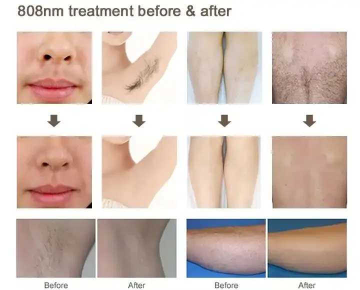 2024 New Design Professional Laser Hair Removal 808nm Diode Laser Machine