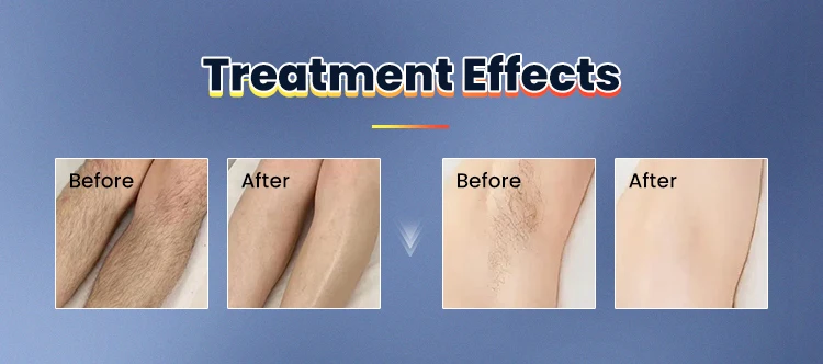 ADSS 1064nm Hair Removal Laser Fiber Alexandrite Laser Hair Removal Machine Price