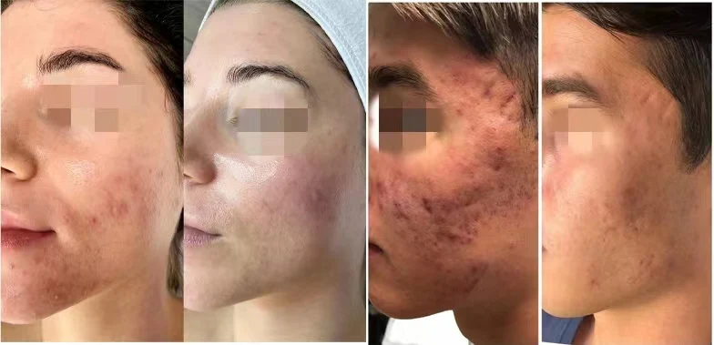 2022 Hot Sale 8 in1 Ultrasonic rf Face Lifting skin care & tools Microdermabrasion/Hydrafaci Dermabrasion Machine