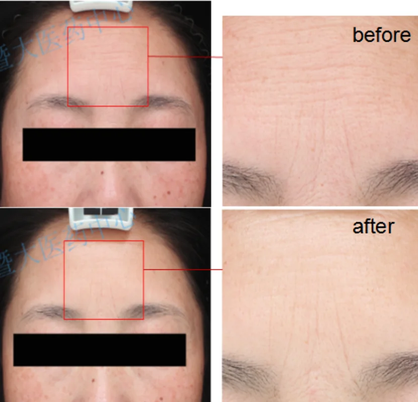 
Choytong bulk price product 1 mg/vial purity 98% SDS-PAGE recombinant human afgf powder 