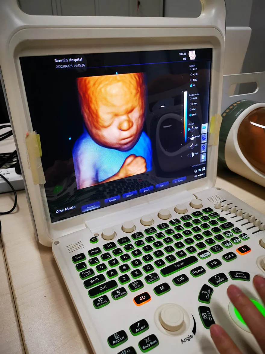 Portable Full-Digital Ultrasound Machine with Electric Power Source Medical Plastic Portable Ultrasound Scan