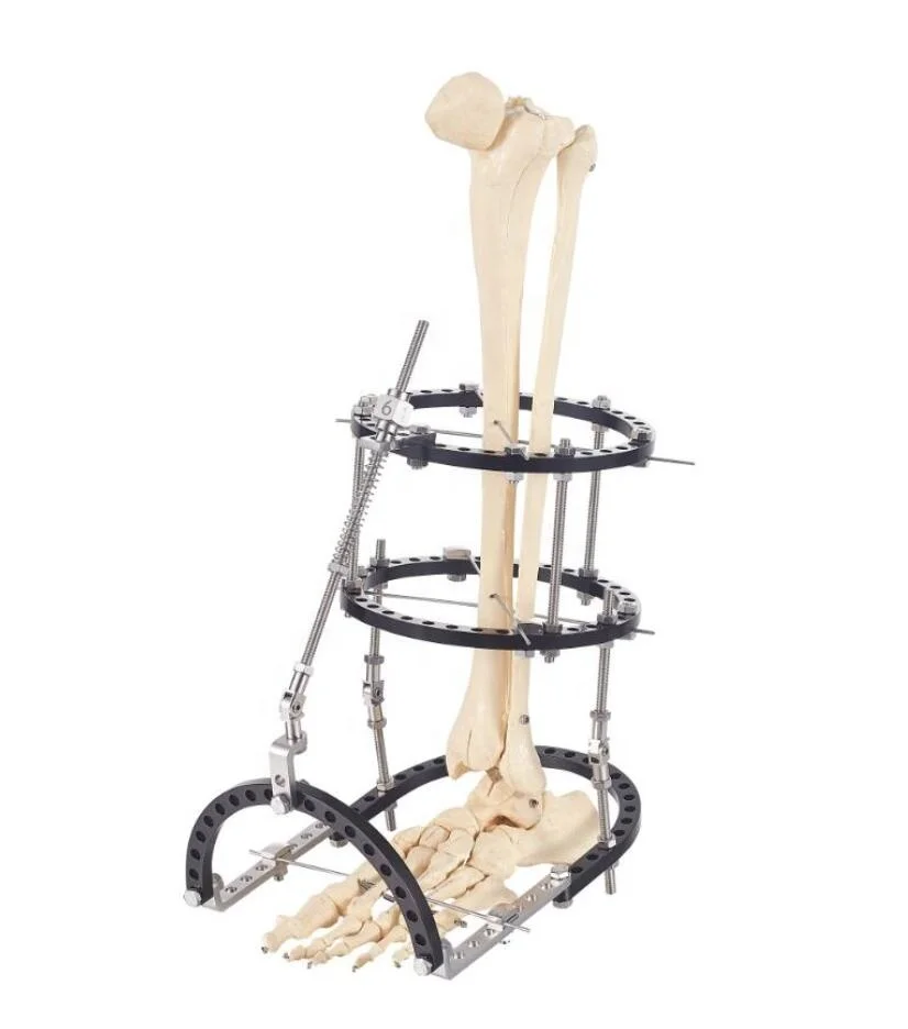 Medical Bone Surgery Orthopedic Circular Type External Fixation Stent for Fracture Implant Materials & Artificial Organs 5 Years