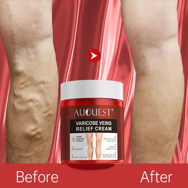 AUQUEST private label Varicose Veins Relief Cream Vasculitis Phlebitis Spider Pain Relief Ointment Medical Plaster Body Care 80g