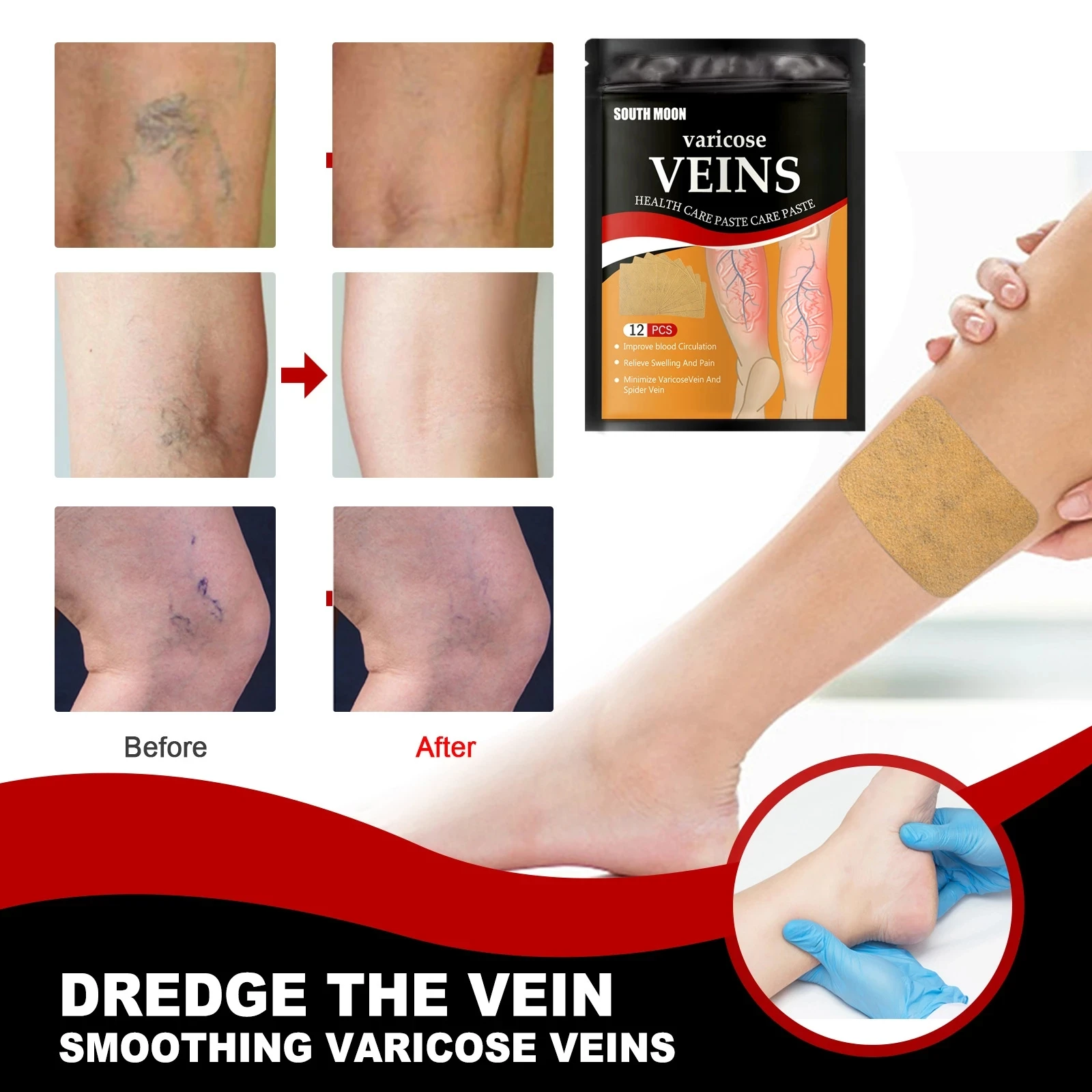 South Moon Varicose Vein Patch Phlebitis Spider Vasculitis Earthworm Leg Pain Plaster for Health Care 12pcs