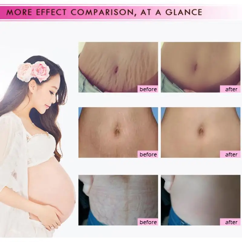 Private Label Best Rtopr 100% Natural Snail  Mango Anti Removal Stretch Mark Cream