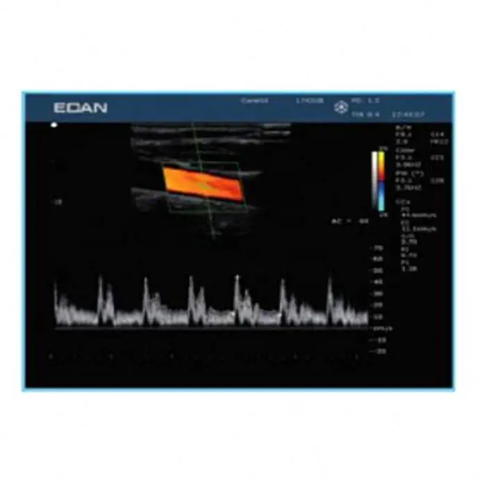 NEW Edan U50 Color Doppler Portable Ultrasound Machine Edan Ultrasound Machine