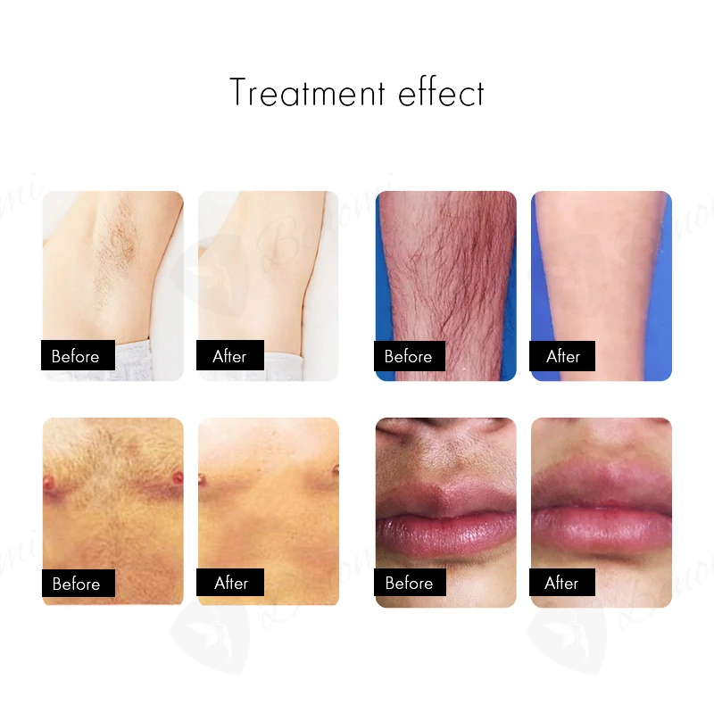 mini flaser desktop 808nm 1200 w diode pico laser skin fraction hair removal 3 wavelenghts portable machine for hair removal an