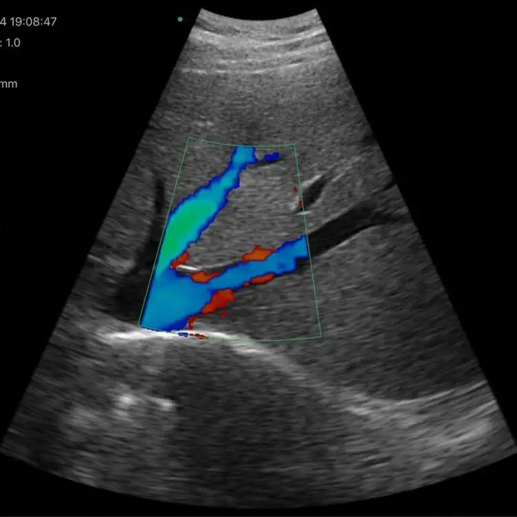 Cardiac 3 in 1 Pocket Double Probes Color Doppler Wireless Ultrasound Probe