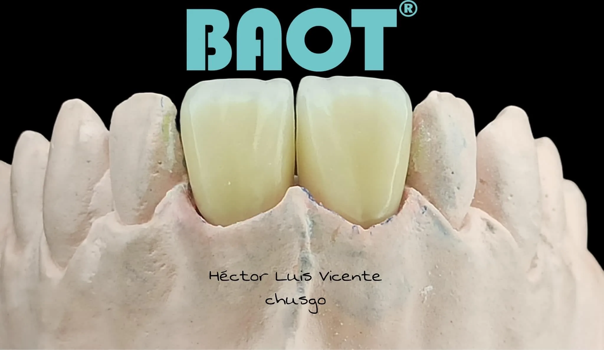 PFM Stain 3g Less Shrinkage Dental Consumables Materials Technician Ceramic Dental Implant S-1A S-1B