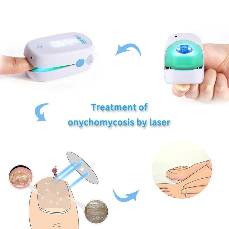 ATANG Onychomycosis fungus nail toenail fungus Nail Fungus Treatment laser