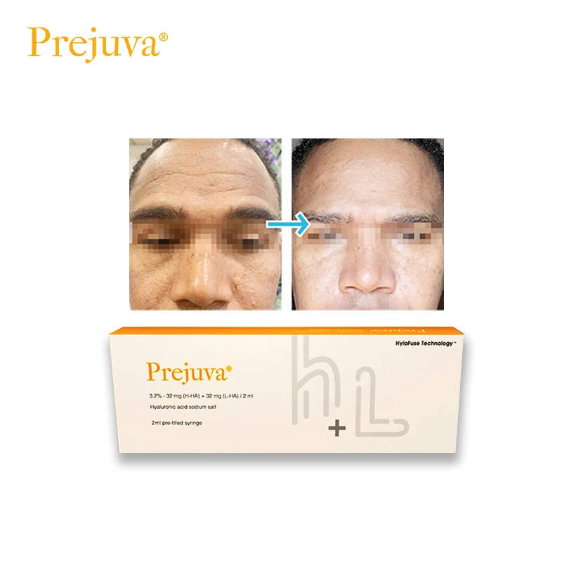 Prejuva Bio-Remodelling Product Hyaluronic Acid Forehead Dermal Filler Anti Wrinkles Skin Booster