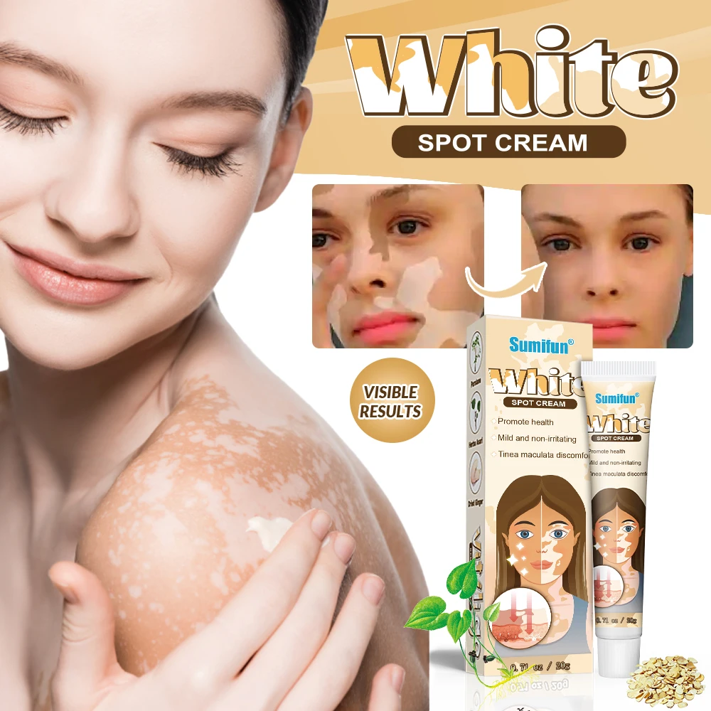 Sumifun White Vitiligo Treatment Improve Skin White Spot Relief Ointment