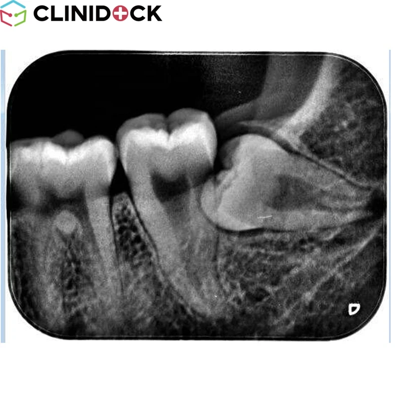 New Style Hot Selling Dental X-ray Unit CDX1006 Portable Mobile Dental Sensor Single Tooth X-ray Machine