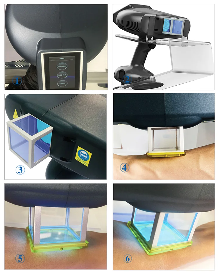 HOT SALE Vitiligo treatment 308nm portable light therapy machine 308nm