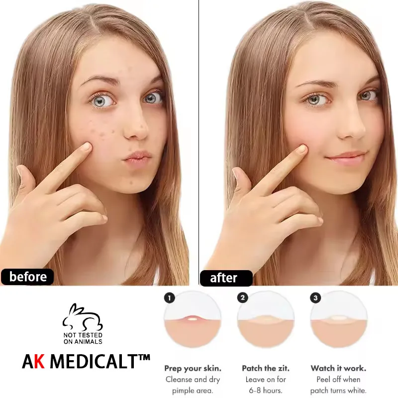 Пользовательские невидимые Гидроколлоидные наклейки Sopt Pimple патчи для прыщей с салициловой и коробкой