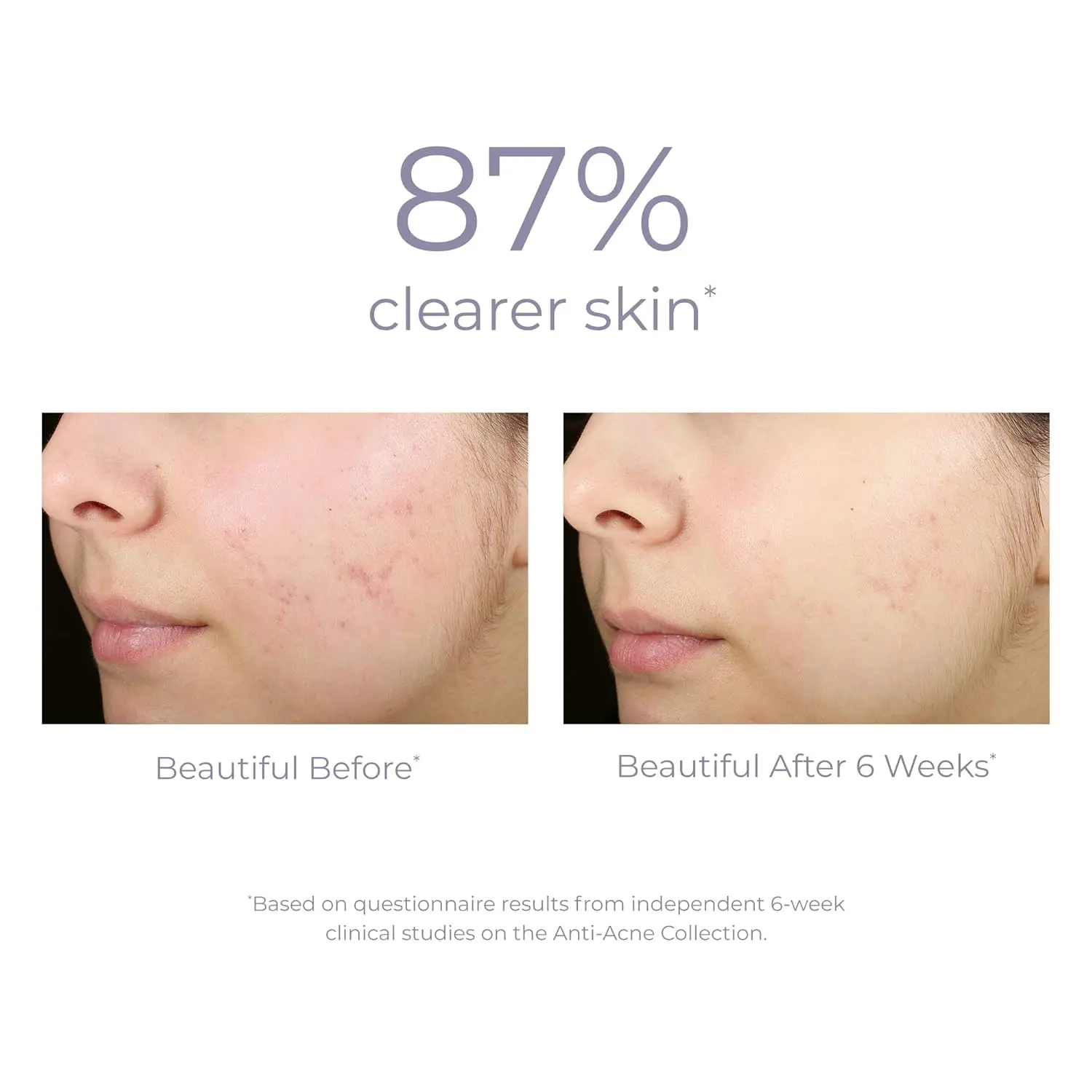 Han Linger Salicylic Acid Anti-acne Treatment Cleanser Purifying Gentle Whitening Tea Tree Oil Chamomile Cleansing Face Cleanser