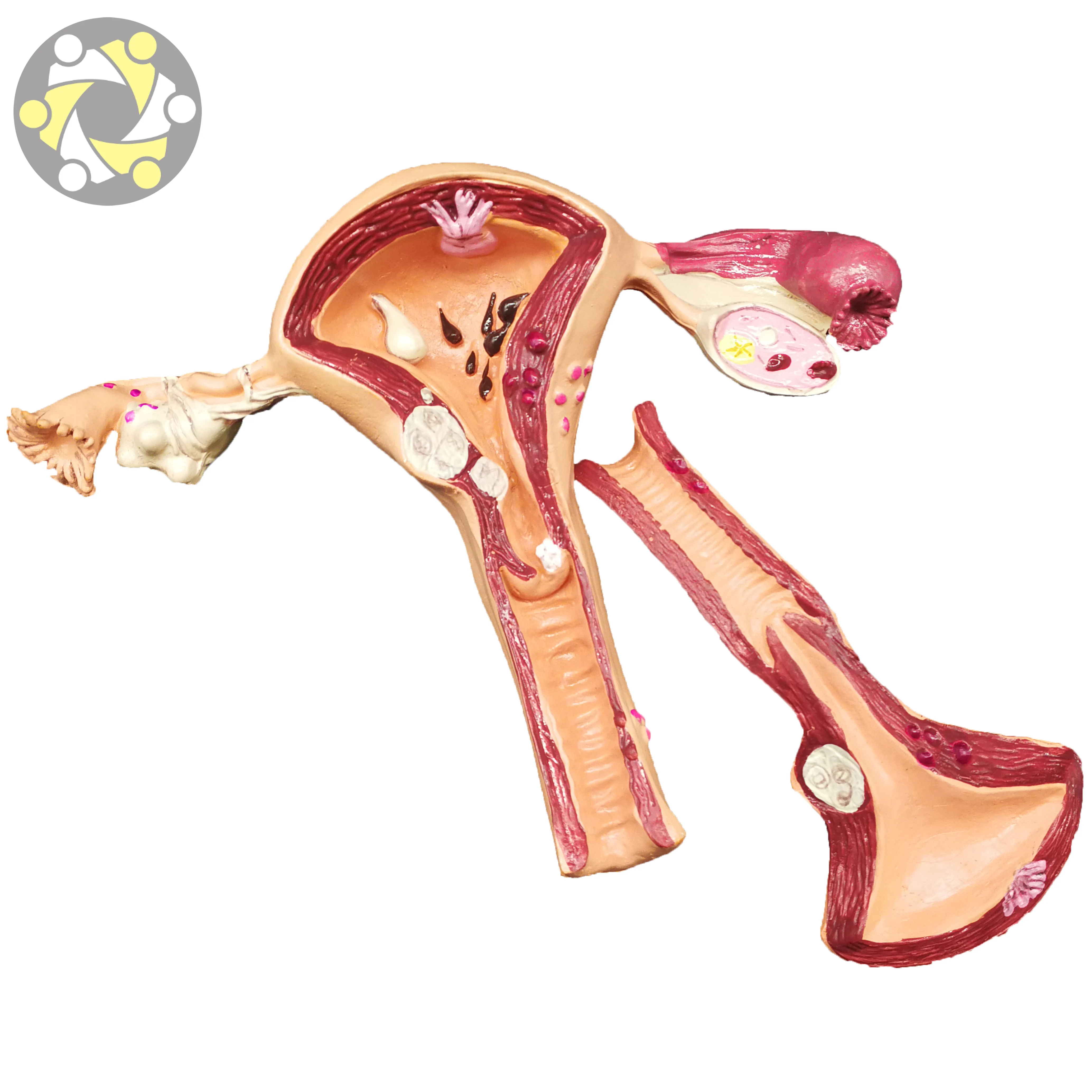 Female Uterine Fibroids Pathological Anatomical Model PVC Material for Medical Science and School Usage